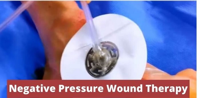 Cpt placement of wound vac